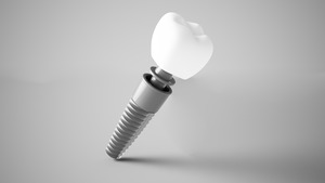 If You Want Dental Implants in Allen, TX