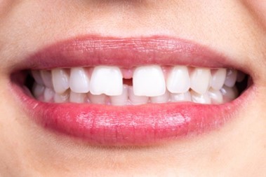 Can You Treat a Gap Between Front Teeth in Allen, TX?